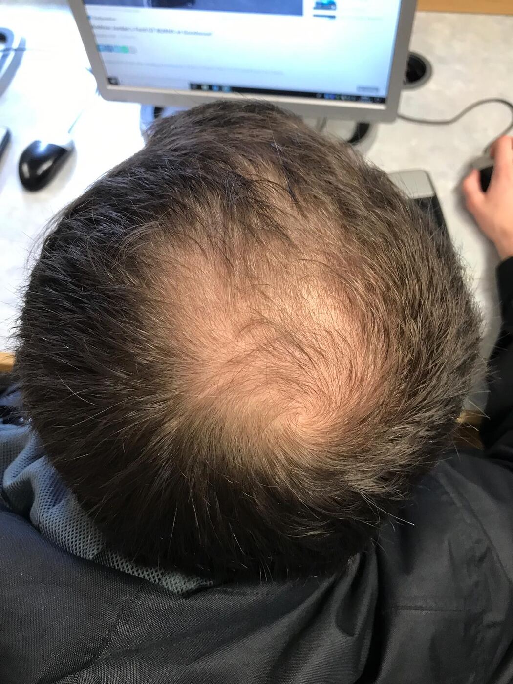 Blick von oben auf den Oberkopf eines Mannes mit lichter werdendem Haar am Wirbel — der Bereich, den die Norwood-Skala einordnet
